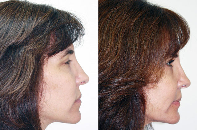 Bite correction orthognathic case profile Before and After view