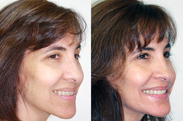 Bite correction orthognathic case 3/4 Before and After view with smile