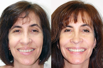 Bite correction orthognathic case frontal Before and After view with smile
