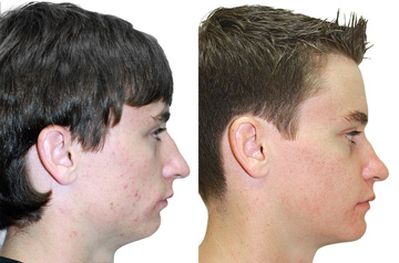 Bite and Face Correction profile view