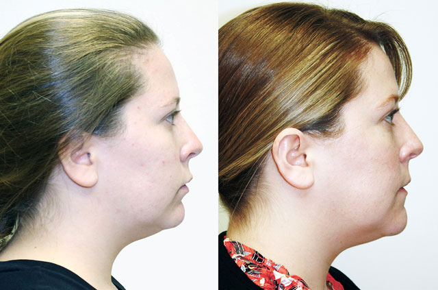 Othognathic surgery patient's profile Before and After view