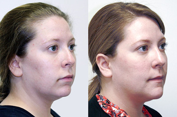 Othognathic surgery patient's three-quaters Before and After view