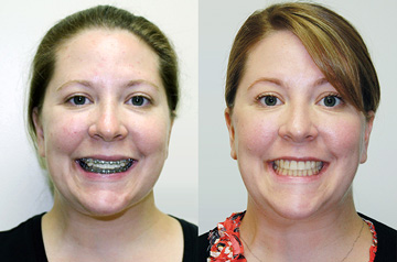 Othognathic surgery patient's front Before and After view with smile