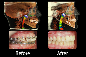 Bite correction and CT-Scan picture Before and After