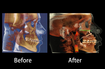 Orthognathic surgery case ct-scan before and after image