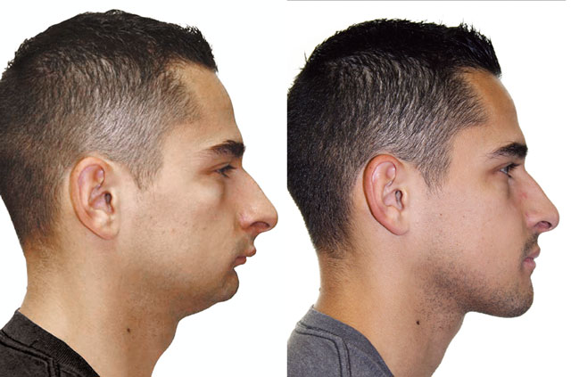 Profile picture before and after corrective jaw surgery