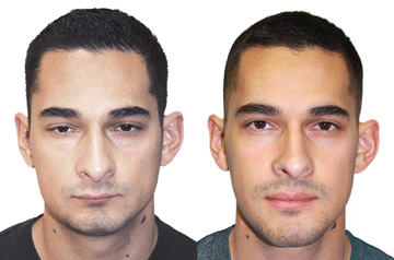 Frontal view picture before and after corrective jaw surgery