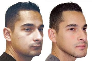 Three quater view picture before and after corrective jaw surgery