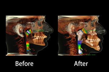 CT-Scan before and after corrective jaw surgery