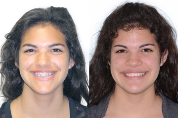 Corrective Jaw Surgery Case Front No Smile