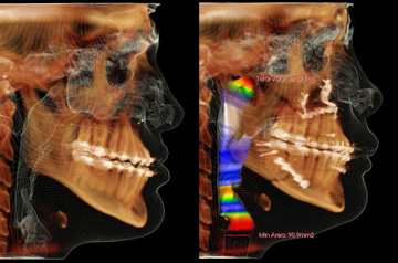 Corrective Jaw Surgery Case CT-Scan