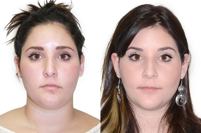 Face asymmetry correction picture before and after