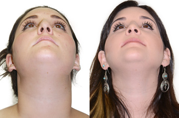 Face asymmetry correction chin view picture before and after