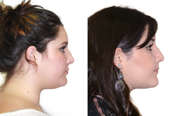 Face asymmetry correction profile view picture before and after
