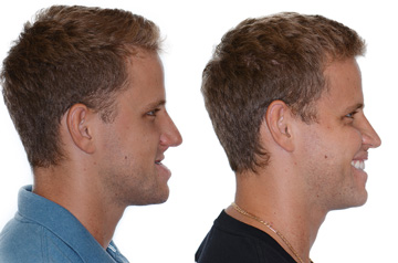 Corrective jaw surgery bite correction and cheek implants profile view with smile
