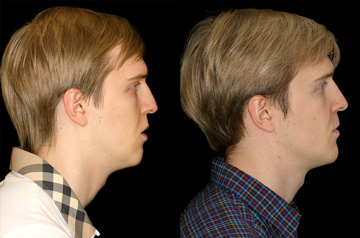 Face, Airway, and Bite Correction profile view