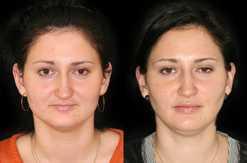 Deep bite correction mandibular, maxillary advancement frontal with no smile before and after