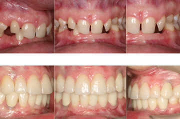 Bite before and after deep bite correction mandibular, maxillary advancement