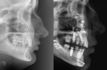 CT Scan Before and After Orthognathic Surgery