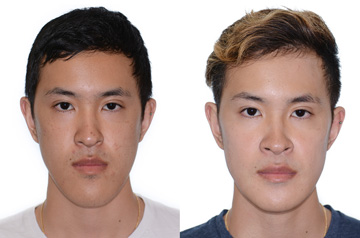 Photographs of the patient orthognathic surgery frontal view with no smile