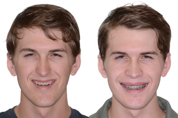 Photographs of the orthognathic surgery patient frontal view with smile