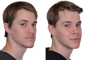Orthognathic surgery frontal view Before and After with no smile