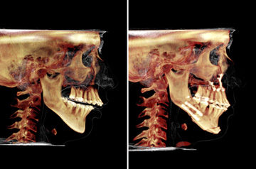 Photographs of the orthognathic surgery patient frontal and profile CT-Scan before and after