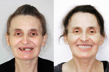Patient before and after All-on-4 and Teeth-in-a-Day™ Surgery performed at Galleria Oral and Maxillofacial Surgery Center, located at Roseville, California 