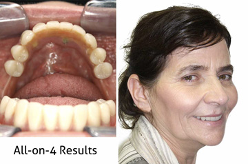 All-on-4 Teeth-in-a-Day™ Frontal, Profile, and Frontal with Smile