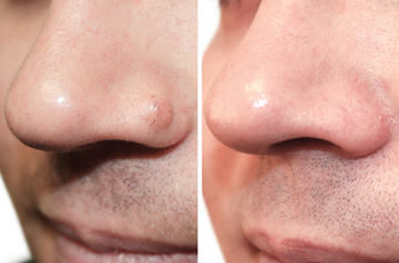 Scarless Mole Removal from Nose Before and After