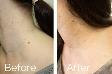 Neck mole scarless removal before and after picture
