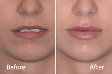 Juvederm&reg; lips before and after fillers with released lips