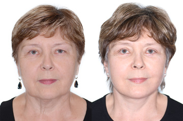 Face lifting surgery results: Before and After, frontal no smile view