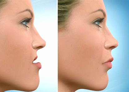 Before and after corrective jaw surgery