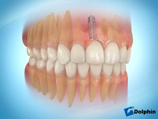 Anterior Tooth Implant