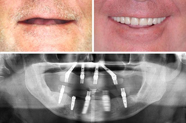 Immediate Implants and Teeth All-On-4