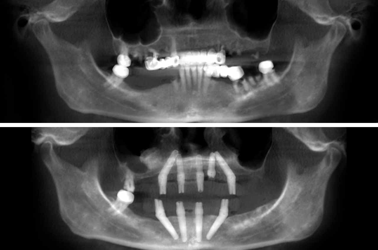 Immediate Implants and Teeth All-On-4 Teeth-In-A-Day