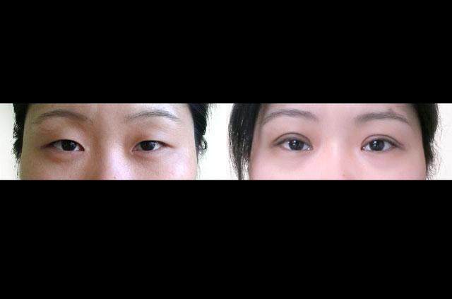 Asian Eyelids Correction