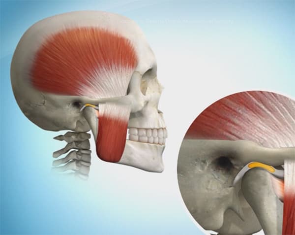 TMJ Disorders Explained