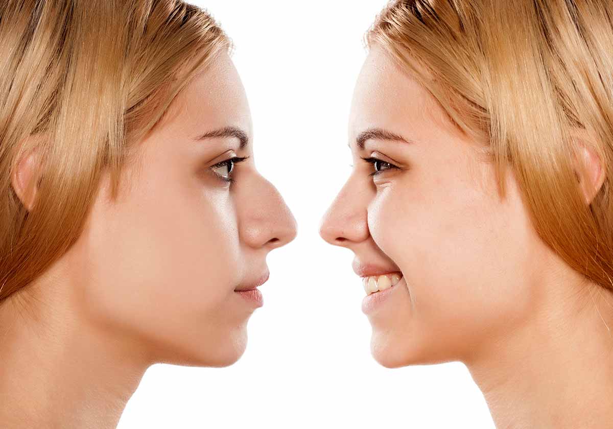 Rhinoplasty Procedures