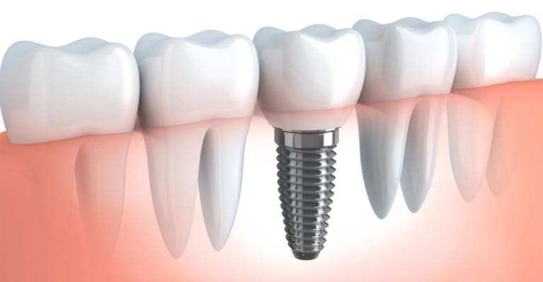 Zygomatic implants for severe upper jaw bone loss