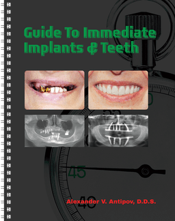 All-on-4 Dental Implants