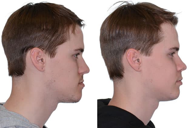 Orthognathic Surgery With Bone Grafting