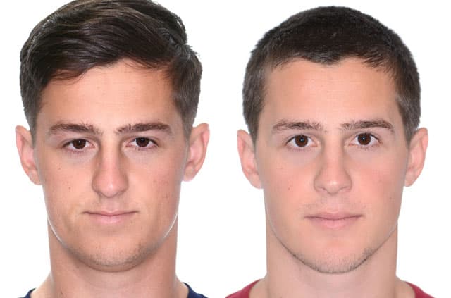 Maxillomandibular Advancement with Genioplasty — corrective jaw surgery case by Dr. Antipov in Roseville, CA