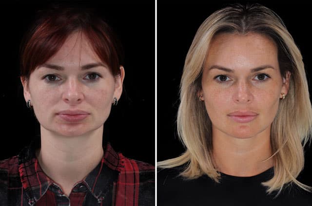 Face Lengthening and Advancement - Aesthetic Jaw Surgery — before and after corrective jaw surgery result by Dr. André-David Kahwach in Roseville, CA