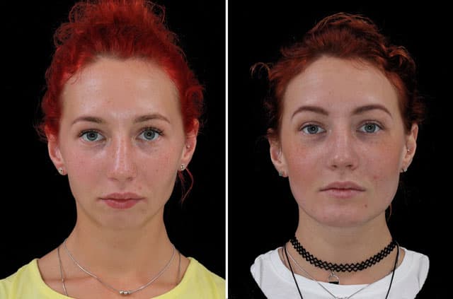 Correction Of Class II Malocclusion — before and after corrective jaw surgery result by Dr. Alexander V. Antipov in Roseville, CA