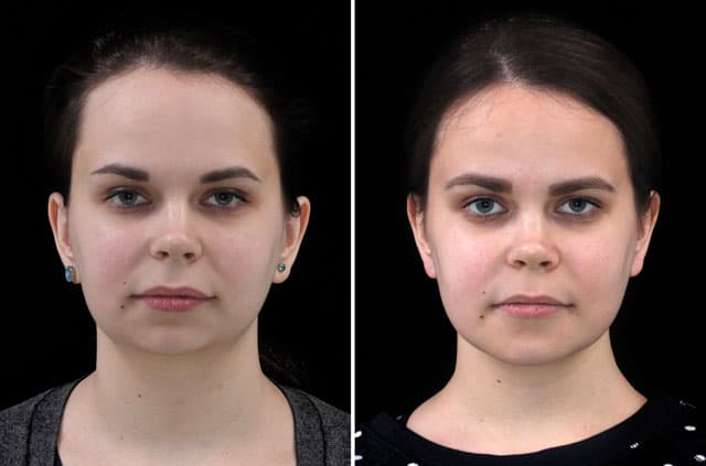 Three-Jaw Orthognathic Surgery for Asymmetric Class II Malocclusion