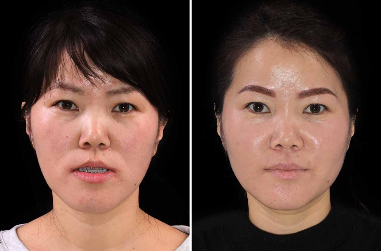 Correction of an Asymmetric Anomaly of Class II Occlusion