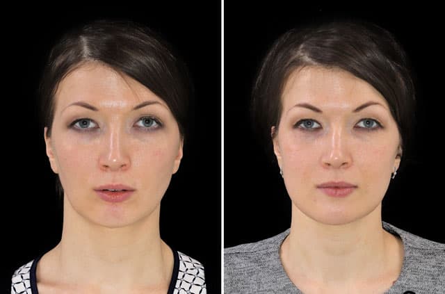 Class II Occlusion Anomaly Corrective Jaw Surgery