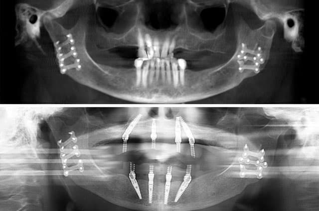 Immediate Implants and Teeth All-On-4 After Jaw Trauma — dental implants case by Dr. Antipov in Roseville, CA